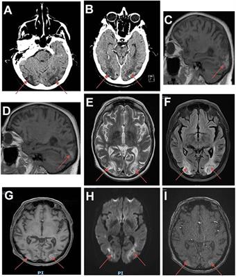 Delayed Posterior Reversible Leukoencephalopathy Syndrome Triggered by FLOT Chemotherapy